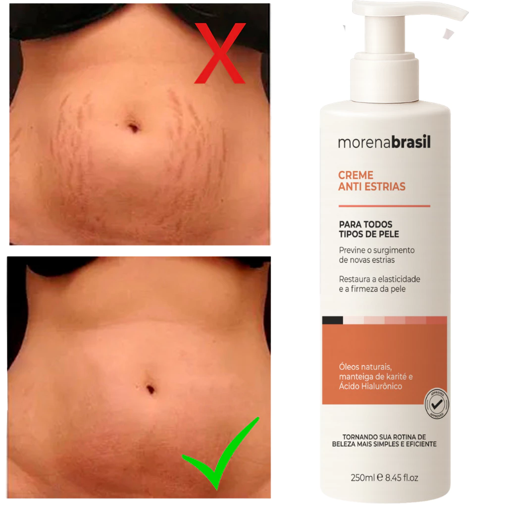 Creme Anti-Estrias – Diga Adeus às Estrias! Previne Novas Estrias & Reforça a Elasticidade Da Pele